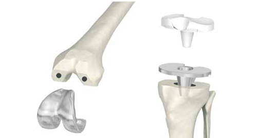 artroplastica totale ginocchio